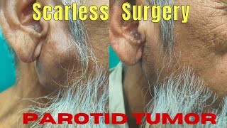 Scarless removal of parotid Tumor Surgery of pleomorphic adenoma in Ranchi by Dr Pankaj Kumar [upl. by Yehs804]