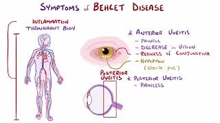 Behcet disease causes symptoms diagnosis treatment pathology [upl. by Briggs280]