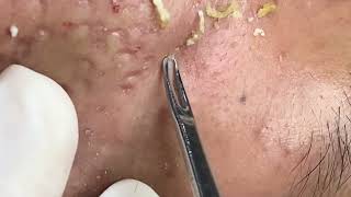 Deepseated acne blackheads EP3 left cheek [upl. by Enyamrahc347]