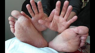 COXSACKIE VIRUS Symptoms Causes Transmission Treatment Hand Foot Mouth disease Herpangina [upl. by Casilde]