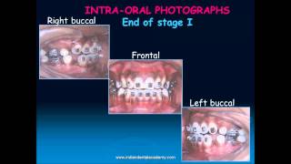 beggs technique part  orthodontic courses by Indian dental academy [upl. by Ellehcam999]