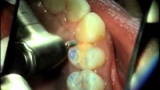 V3105  Uncomplicated Occlusal Equilibration [upl. by Peer]