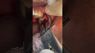 upper 3rd molar Extraction [upl. by Mikeb]