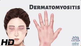 Dermatomyositis Everything You Need To Know [upl. by Eilyak901]