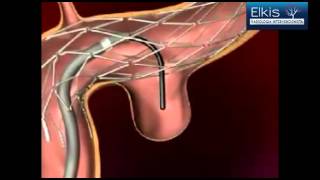 Embolização Vascular  Aneurisma Cerebral [upl. by Einahpet879]