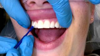 Tips For Applying Fluoride Varnish [upl. by Rheingold]