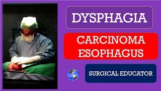 CARCINOMA ESOPHAGUS How To DIAGNOSE amp TREAT DYSPHAGIA [upl. by Ahsikram936]