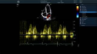 〖Echocardiography〗 Measuring  the pulmonary veins signal TTE [upl. by Buke]