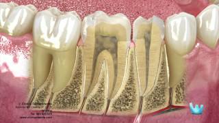 Endodoncia desvitalizar el nervio dental [upl. by Aeriela]