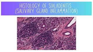 Histology of Sialadenitis Salivary Gland Inflammation [upl. by Cornelia]