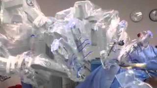 Docking Robotic right hemicolectomy Dr Douglas A Brewer [upl. by Yevad]