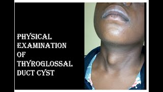 THYROGLOSSAL DUCT CYST EXAMINATION [upl. by Bibi]