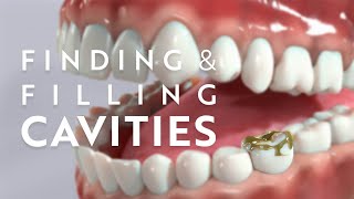 The process of finding and filling dental cavities [upl. by Kennett672]