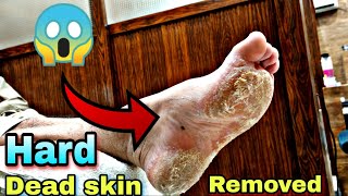 Dead skin Remove Pedicure Treatment of Foot 🔥  Footcare33 [upl. by Kalil748]