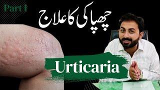 Types of Urticaria amp Homeopathy Treatment [upl. by Binky317]