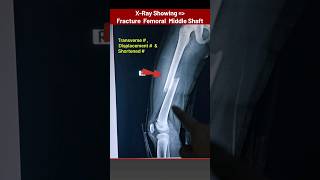 Thigh Bone Femur Fracture Xray xray radiology radiography bones Fracture radiographerusn [upl. by Eilyw735]