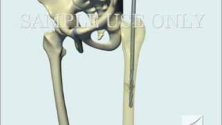 Femoral Fracture Fixation Surgery Intramedullary Nail [upl. by Jea730]