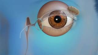 Blocked Tear Duct Treatment Through Oculoplastics Endoscopic DCR [upl. by Ahsele166]