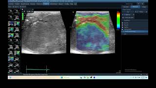 IQ 279 LIVER ULTRASOUND HEPATOMA ECHOPAC ANALYSIS ECHOCARDIOGRAPHY ELASTOGRAPHY 2 [upl. by Yesteb831]