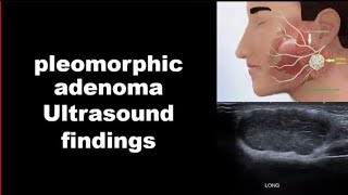 pleomorphic adenoma ultrasound findings [upl. by Heymann]