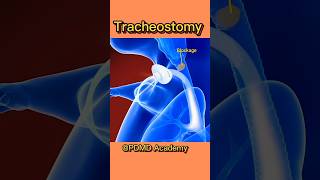 How Tracheostomy Tube Works  Tracheostomy medicine [upl. by Akeber]