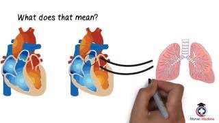 Tetralogy of Fallot [upl. by Ronyar]