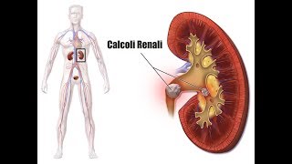 Soffri di calcoli renali Evita questi alimenti per non formare calcoli renaliVideo informativo [upl. by Yesnek858]