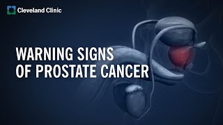 10 Warning Signs of Prostate Cancer [upl. by Eimmat]