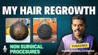 How i regrow my hair without hair transplant Hair loss in Tamil hair haircare transformation [upl. by Dosia]