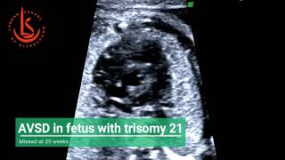 AVSD for fetus with Downs syndrome missed at 20 weeks scan [upl. by Yerdna]