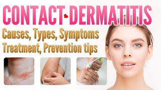 Contact Dermatitis Causes Types Symptoms Treatment Prevention  contact eczema [upl. by Aiker]