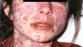 Dermatologic Emergencies 2 StevensJohnson Syndrome Toxic Epidermal Necrolysis [upl. by Munniks]