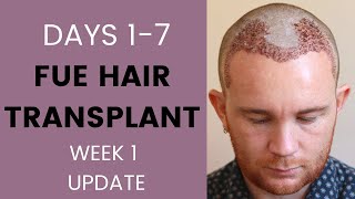 FUE Hair Transplant Week 1  Recovery healing sleeping itching swelling travelling [upl. by Hestia]