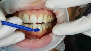 Fluoride varnish application [upl. by Ynaffyt866]