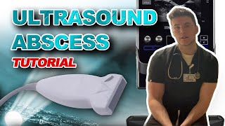 Ultrasound Guided Abscess Drainage [upl. by Ocsirf56]