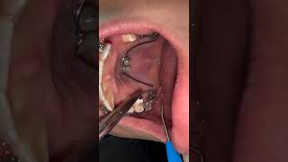 تقويمالأسنان orthodontics braces teeth oralhealth dentistviralviralvideo viralshortsvideo [upl. by Kir]