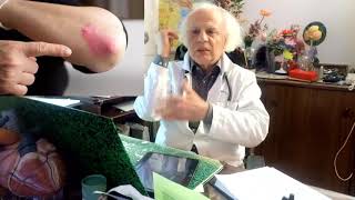 247 PSORIASIS OU ECZEMA MALADIE DE LA PEAU VIN HYPERTENSION RHUAMTISME [upl. by Yanarp]