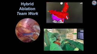 Hybrid atrial fibrillation ablation [upl. by Yggep]