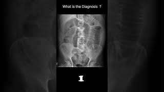 Small bowel obstruction Abdominal Xray  Abnormalities Normal reference 63 radiologychannel007 [upl. by Anitnegra]