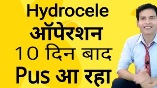 10 दिन बाद pus आ रहा Hydrocele operation के बाद [upl. by Ahsikat]