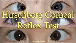 Hirschberg Corneal Reflex Test Principles and Procedure [upl. by Nesaj]