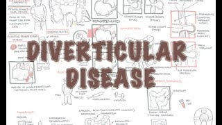 Diverticular Disease diverticulitis  Overview [upl. by Quent505]