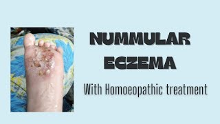 Numular eczema [upl. by Yodlem]