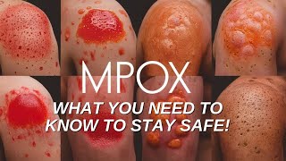 Mpox Outbreak Explained What You Need to Know to Stay Safe [upl. by Zetrok]