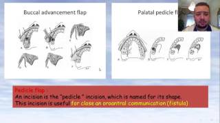 Dr Mohammad Busher Alawa Overview in principles of surgical exodontia [upl. by Mulderig]