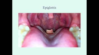 Epiglottitis  CRASH Medical Review Series [upl. by Prudence]