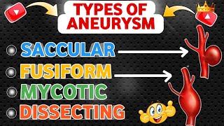 Understanding Types Of Aneurysm  Saccular  Fusiform  Mycotic  Dissecting 😍 [upl. by Narhem225]