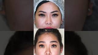 Botox Allergan allergan botulinumtoxin botox antiwrinkle antiagingtreatment skinevo [upl. by Ecnaiva]