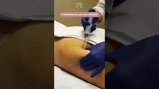 💉 Ozonoterapia contra la celulitis [upl. by Amero]