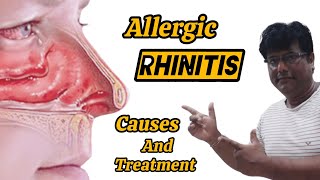 Allergic Rhinitis Causes and Treatment [upl. by Elawalo614]